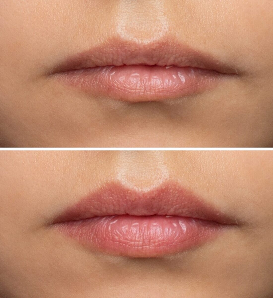 A,Young,Woman's,Lips,Before,And,After,Augmentation,,Front,View.