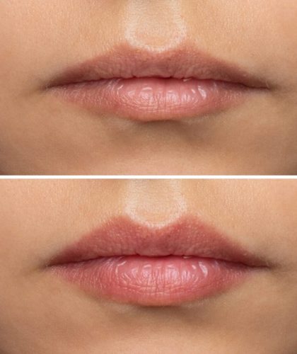 A,Young,Woman's,Lips,Before,And,After,Augmentation,,Front,View.